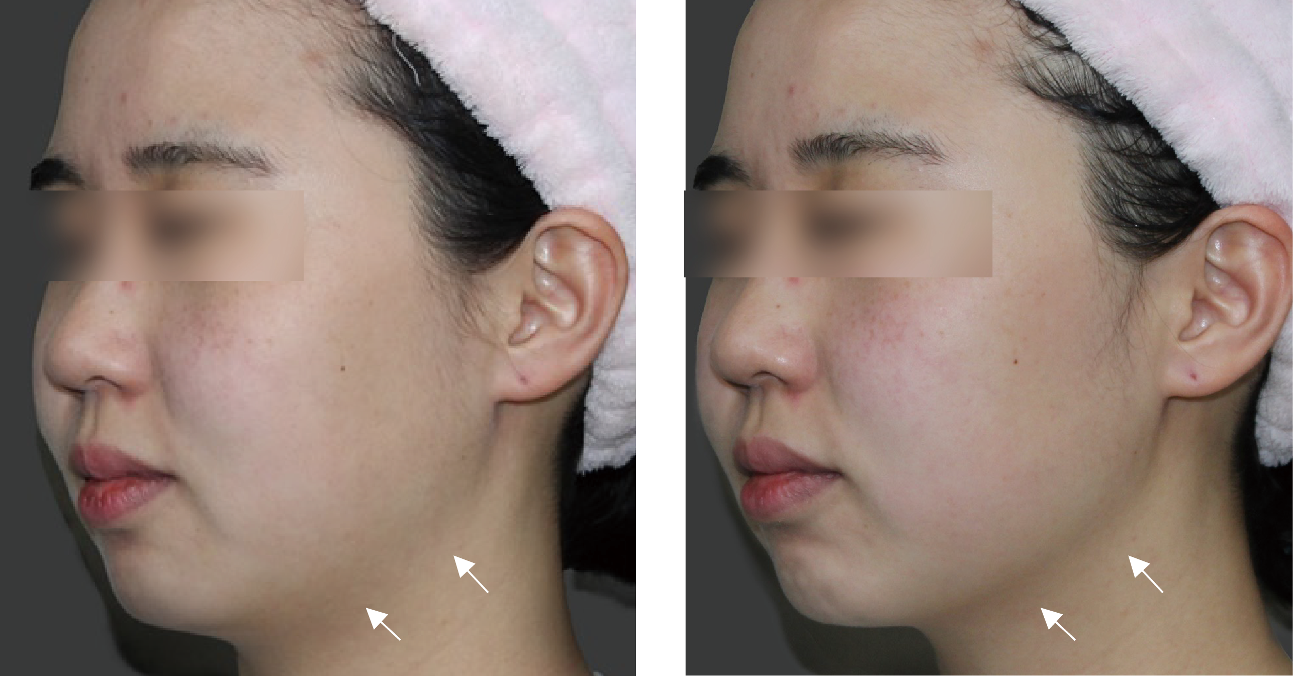 Oligio X 輪廓重塑 · Contour 療程前後記錄