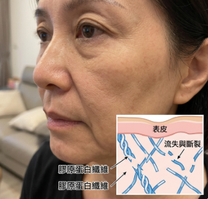 膠原蛋白流失